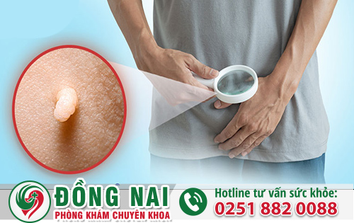 Cẩn Thận Sùi Mào Gà Ở Nam Giới