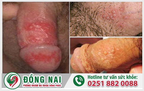 Bệnh do Herpes Simplex Virus gây ra là bệnh gì?