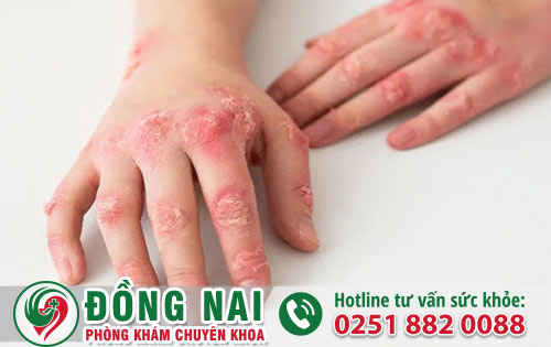 Bệnh giang mai và những thông tin chi tiết cần biét