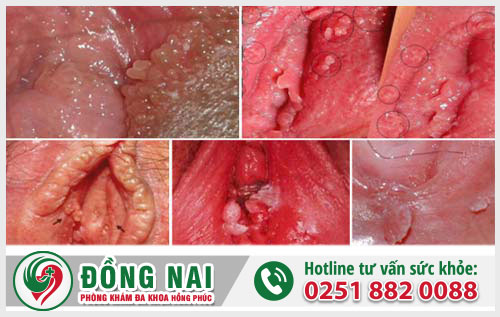 Bệnh mồng gà là bệnh gì?