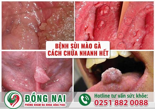 Bệnh sùi mào gà và cách chữa nhanh hết