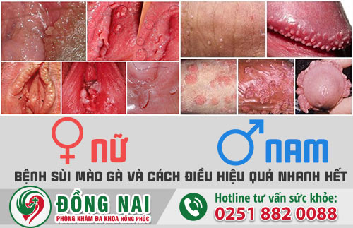 Bệnh sùi mào gà và cách điều trị hiệu quả nhanh hết