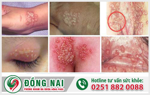 Biểu hiện, nguy hại của mụn rộp sinh dục