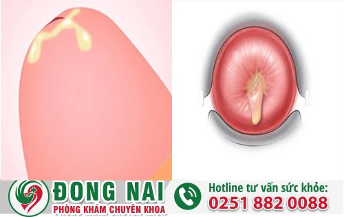 Bộ Phận Sinh Dục Chảy Mủ Là Dấu Hiệu Bệnh Gì?