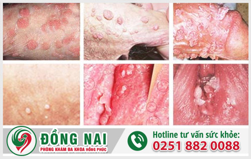 Bộ phận sinh dục mọc mụn có phải mắc bệnh xã hội