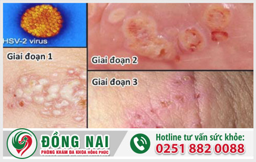 Bộ phận sinh dục mọc mụn có phải mắc bệnh xã hội