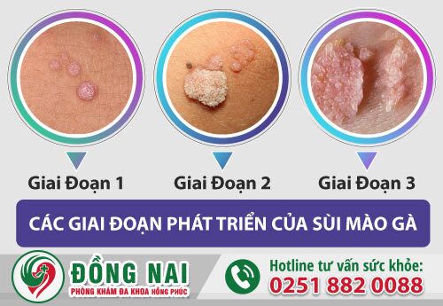 Các giai đoạn phát triển của sùi mào gà