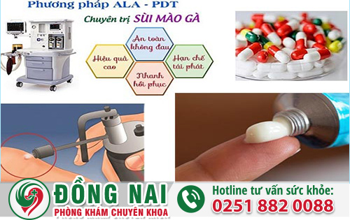 Điều trị sùi mào gà ở nam giới