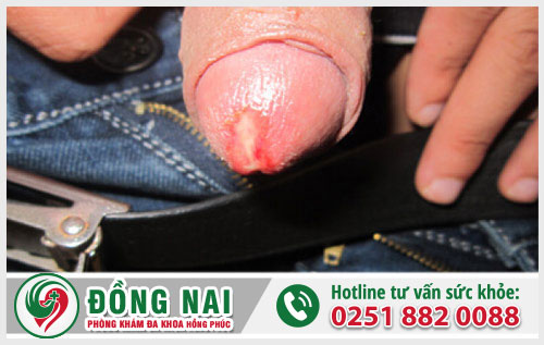 Cậu nhỏ chảy mủ là dấu hiệu cảnh báo bệnh nguy hiểm