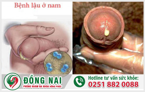 Chẩn đoán đúng bệnh dương vật chảy mủ