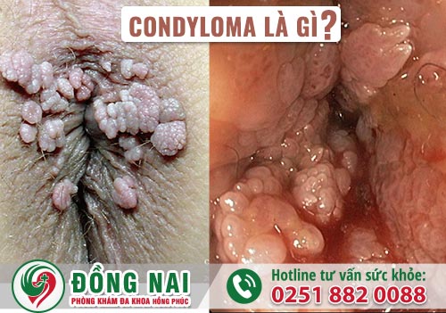Condyloma là gì? Nguyên nhân và cách điều trị