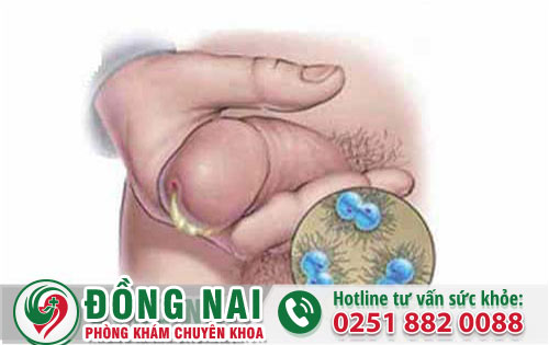 Đầu Dương Vật Bị Chảy Mủ Có Phải Biểu Hiện Của Bệnh Lậu