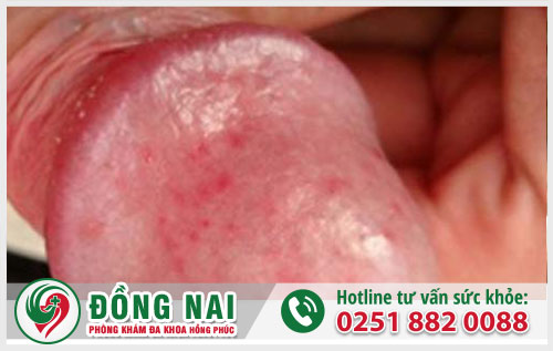 Đầu dương vật nổi mụn là vì sao?