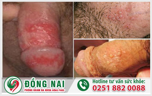 Đầu dương vật nổi mụn là vì sao?