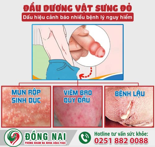 Đầu dương vật sưng đỏ có nguy hiểm không?