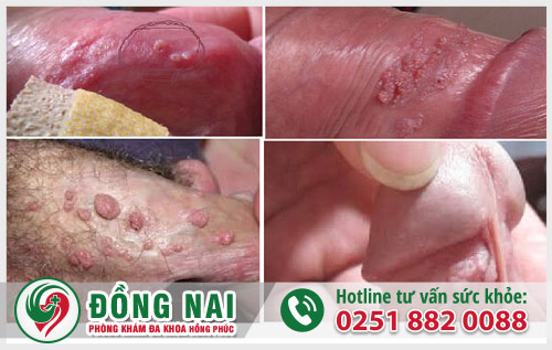 Dấu hiệu sùi mào gà ở nam giới