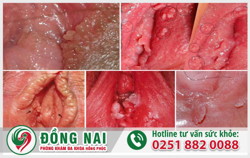 Dấu hiệu sùi mào gà ở nữ giới