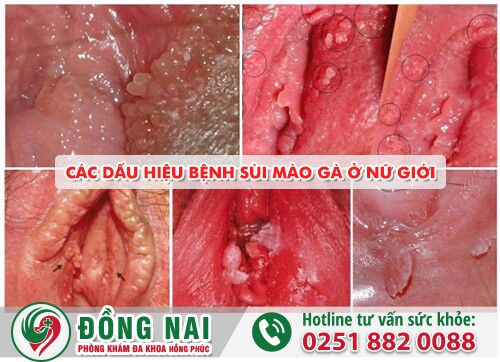 Các dấu hiệu sùi mào gà ở nữ giới