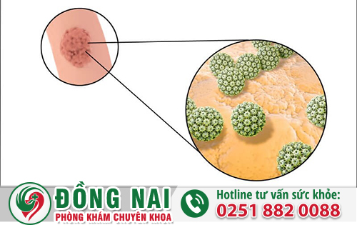 Dấu hiệu nghi ngờ sùi mào gà 