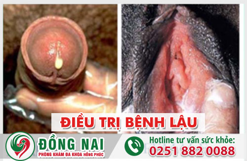 Phương pháp điều trị bệnh lậu hiệu quả, tiết kiệm chi phí