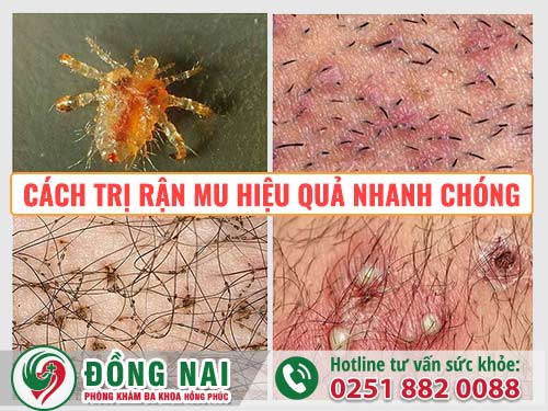 Cách trị rận mu hiệu quả nhanh chóng