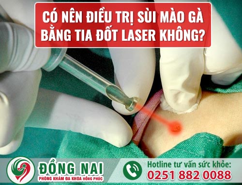 Có nên điều trị sùi mào gà bằng tia đốt laser không?