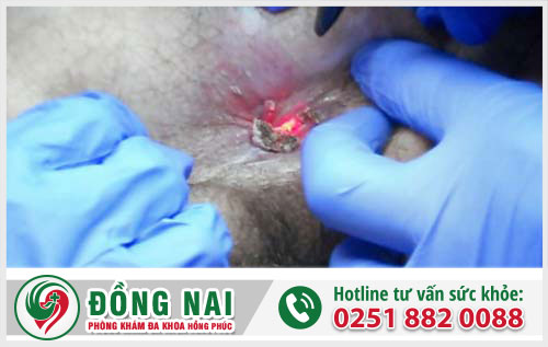 Đốt sùi mào gà có hiệu quả không?