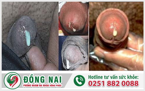 Dương vật chảy dịch do đâu và hướng khắc phục