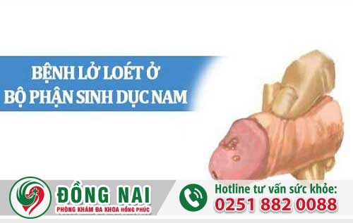 Dương Vật Lỡ Loét Cảnh Báo Bệnh Xã Hội Nguy Hiểm Nào?