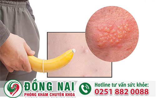 Dương vật nổi mụn đỏ là dấu hiệu của nhiều bệnh lý xã hội