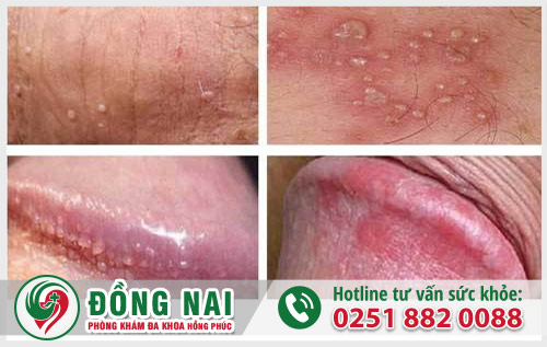 Dương vật sưng đỏ - Dấu hiệu cảnh báo nhiều bệnh lý nguy hiểm