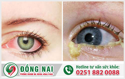 Hình ảnh bệnh lậu ở nam nữ