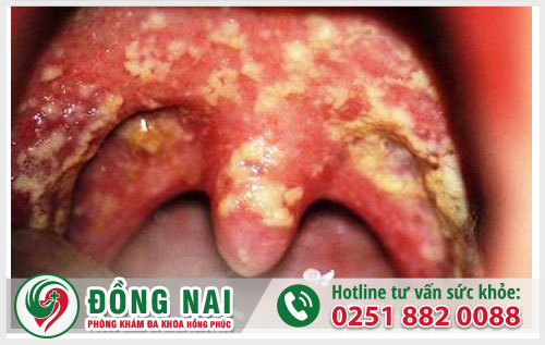 Hình ảnh bệnh lậu ở nam nữ