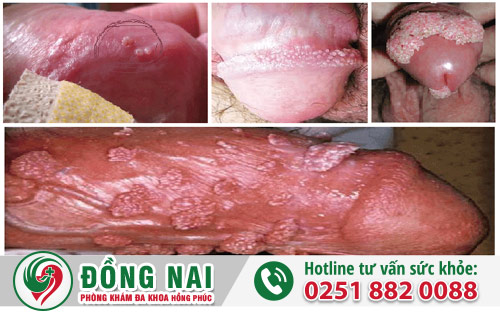 Sùi mào gà nam ở rãnh quy đầu, quy đầu, thân dương vật, tinh hoàn bìu