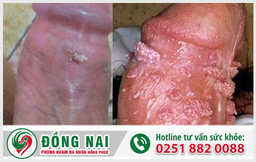 Khám sùi mào gà ở đâu tốt?