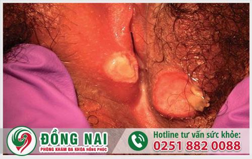 Lở loét âm đạo - Dấu hiệu nguy hiểm chị em cần chú ý
