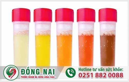 Màu nước tiểu là bệnh gì?