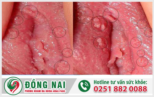 Mọc mụn thịt ở môi lớn có phải là sùi mào gà?