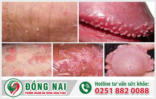 Một số thông tin về chi phí hỗ trợ điều trị sùi mào gà