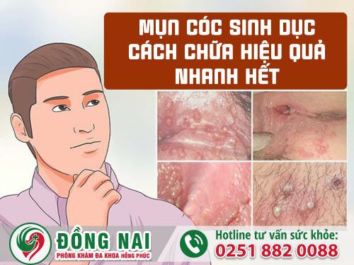 Mụn cóc sinh dục, cách chữa hiệu quả nhanh hết
