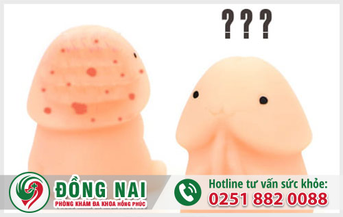 Mụn quy đầu là bệnh gì?