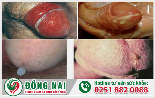 Những căn bệnh nguy hiểm khi quan hệ bằng miệng
