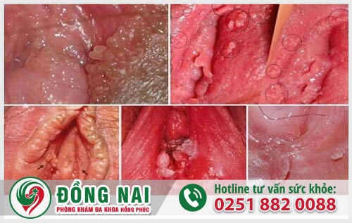 Triệu chứng nổi mụn âm đạo của bệnh sùi mào gà