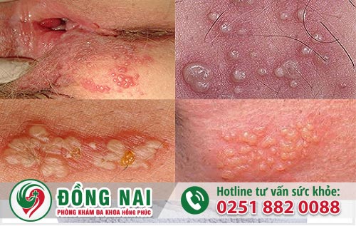 Mụn rộp sinh dục gây ra tình trạng nổi mụn âm hộ