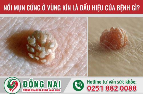 　　Nổi mụn cứng ở vùng kín là dấu hiệu của bệnh gì?