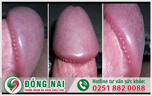 Nổi mụn ở rãnh dương vật - dấu hiệu bệnh sùi mào gà