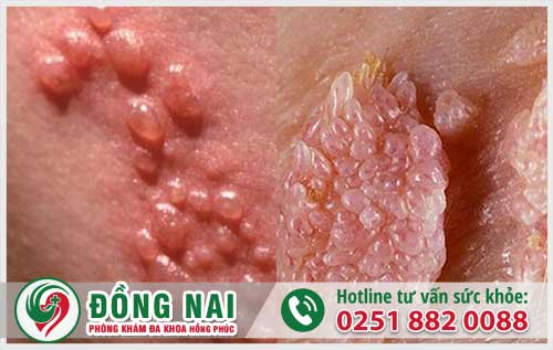 Quan hệ bằng miệng lây lan những bệnh gì?