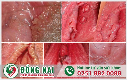 Dấu hiệu sùi mào gà gây đau rát vùng kín