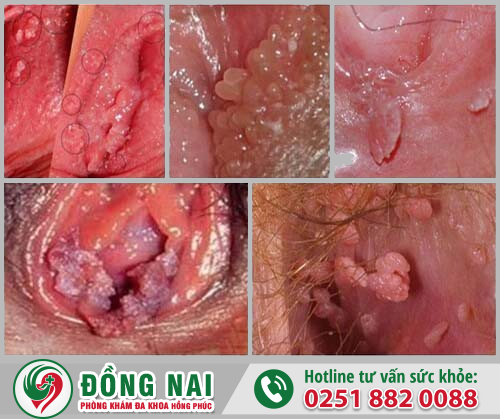 Sùi mào gà âm đạo có nguy hiểm không? Chữa trị ra sao?