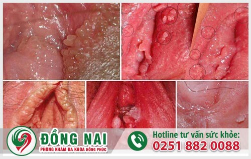 Sùi mào gà âm vật - Dấu hiệu phát hiện bệnh sớm